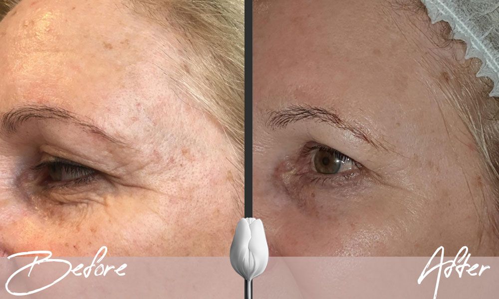 before and after microneedling treatments for age spots and wrinkles